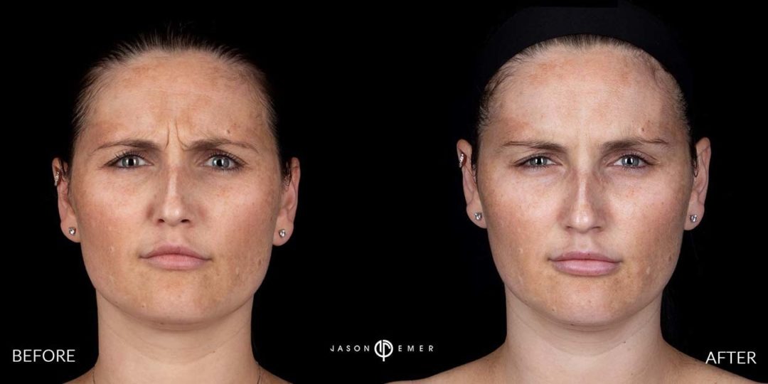 Botox-before-and-after_03-1080x540