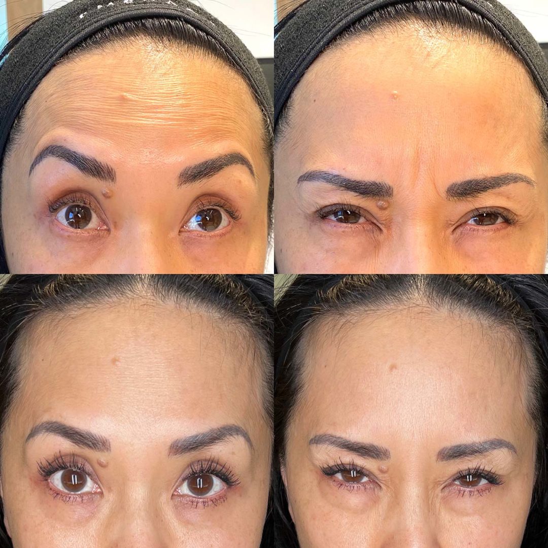 Botox-before-and-after2_01-1080x1080