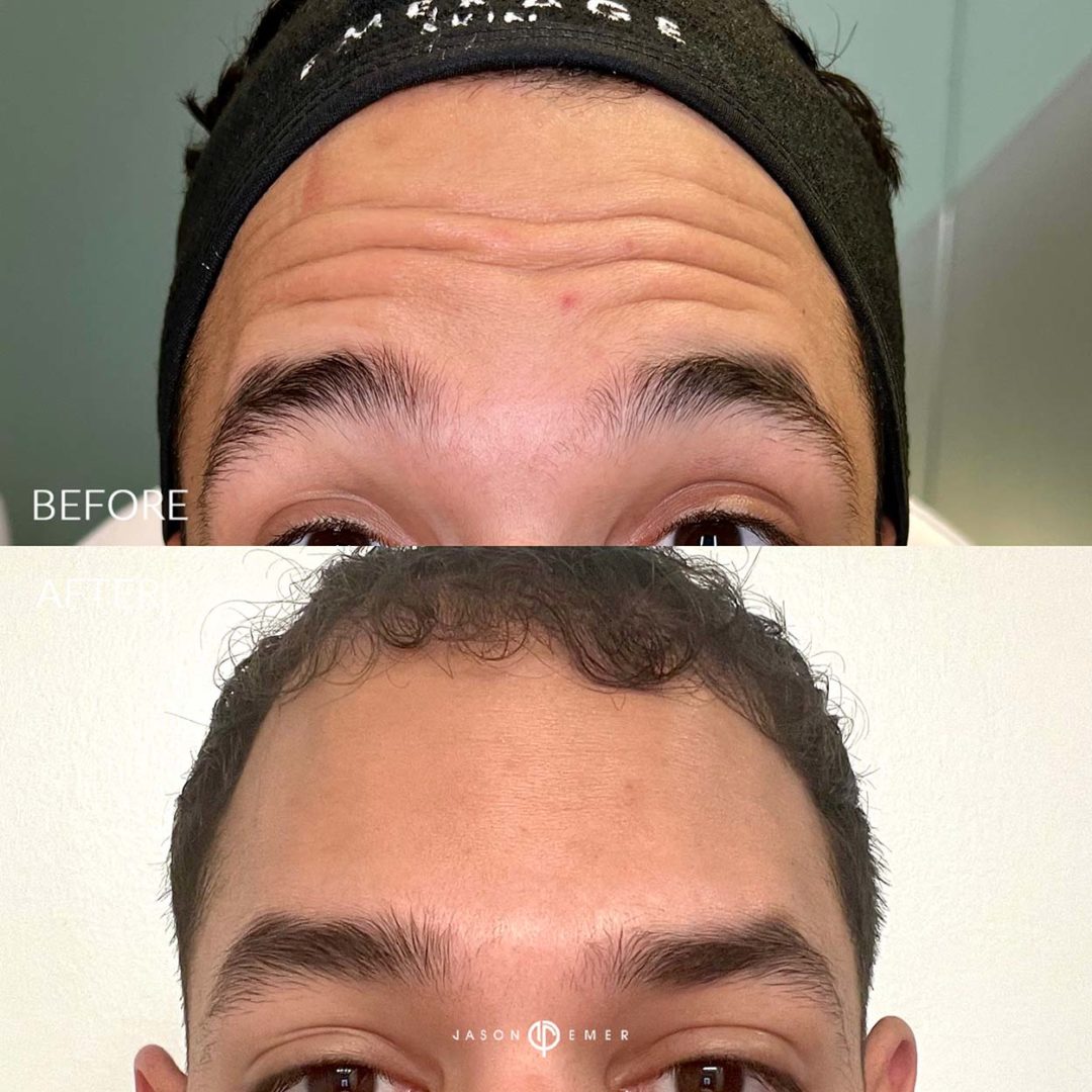 Botox-before-and-after4_01-1080x1080