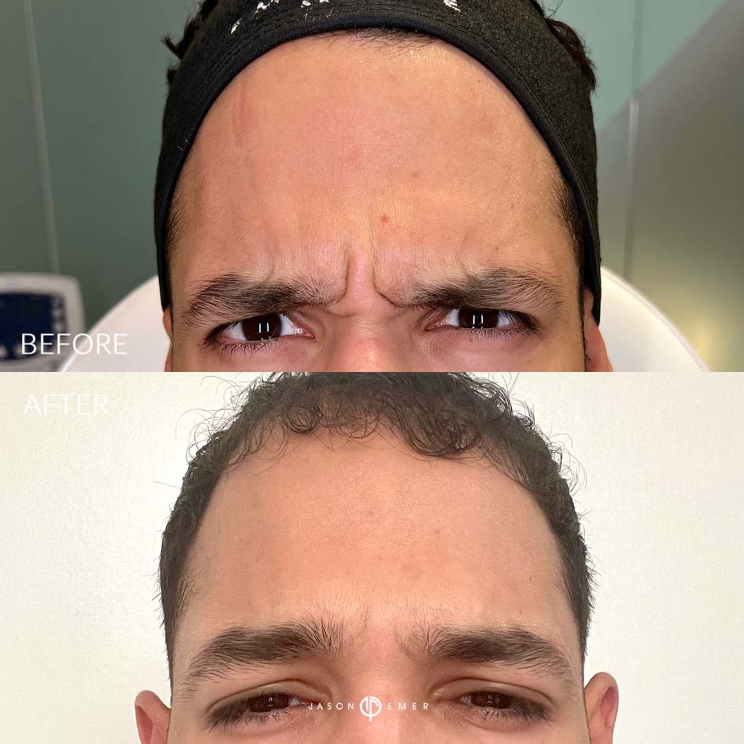 Botox-before-and-after4_02-1080x1080