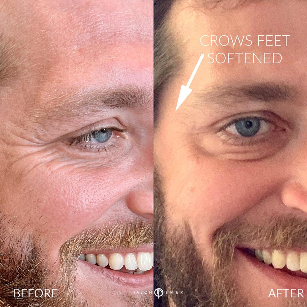 botox-bxa-1080x1080