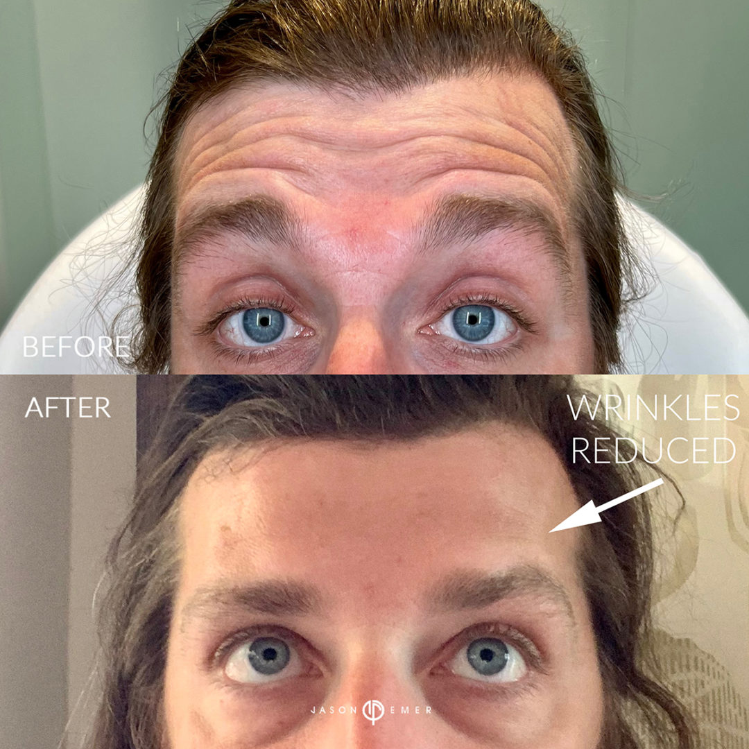 botox-bxa2-1080x1080