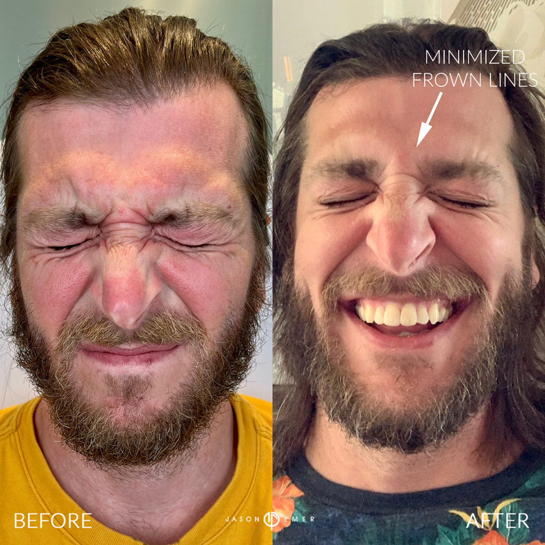 botox-bxa3-1080x1080