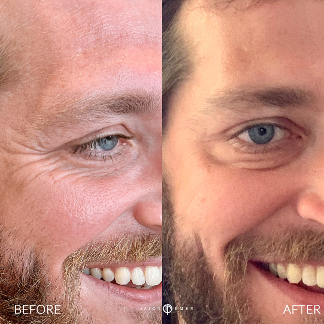 botox-bxa4-1080x1080