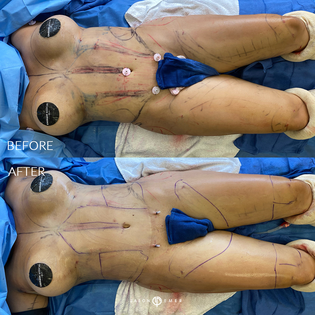 full-body-hi-def-lipo-female-bxa