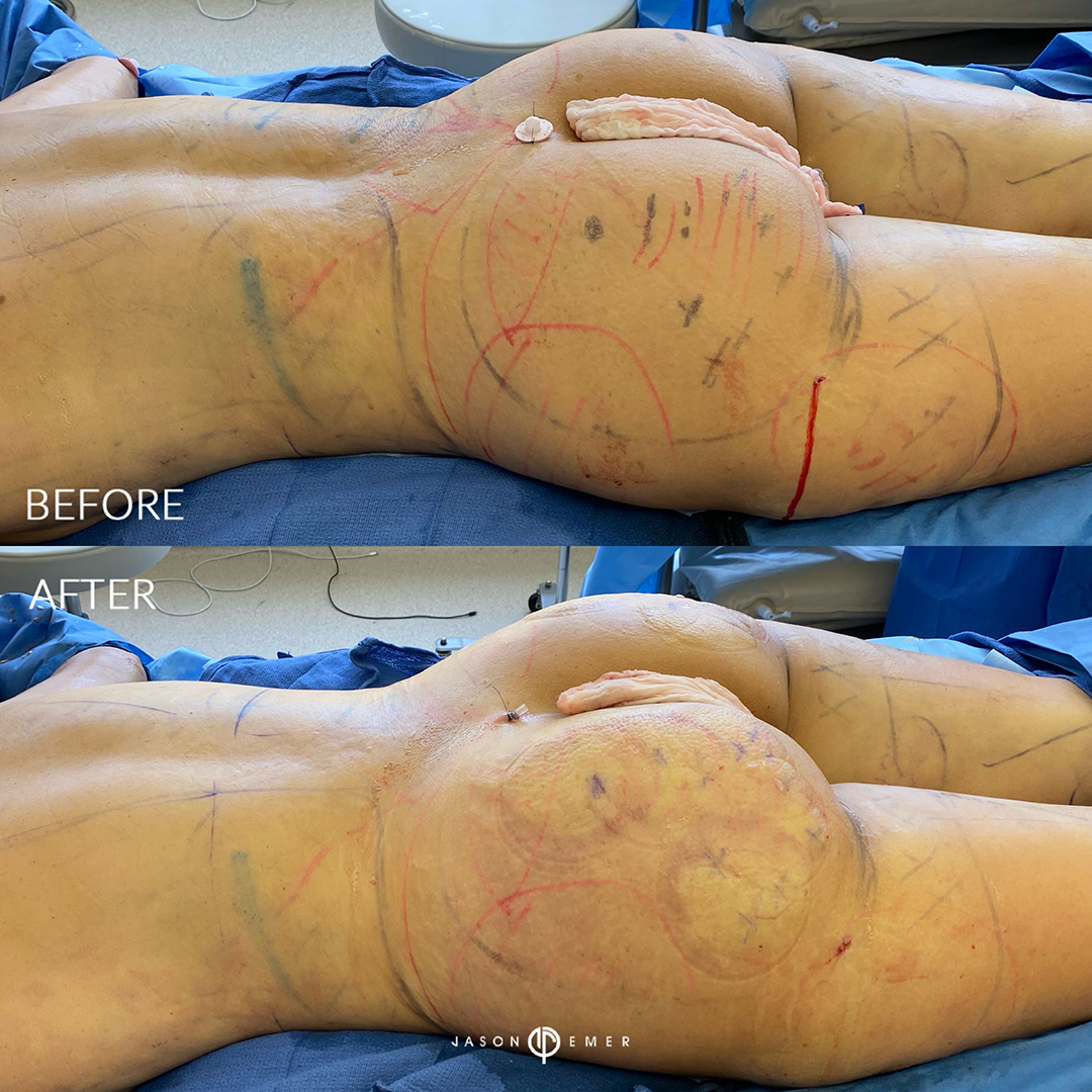 full-body-hi-def-lipo-female-bxa1