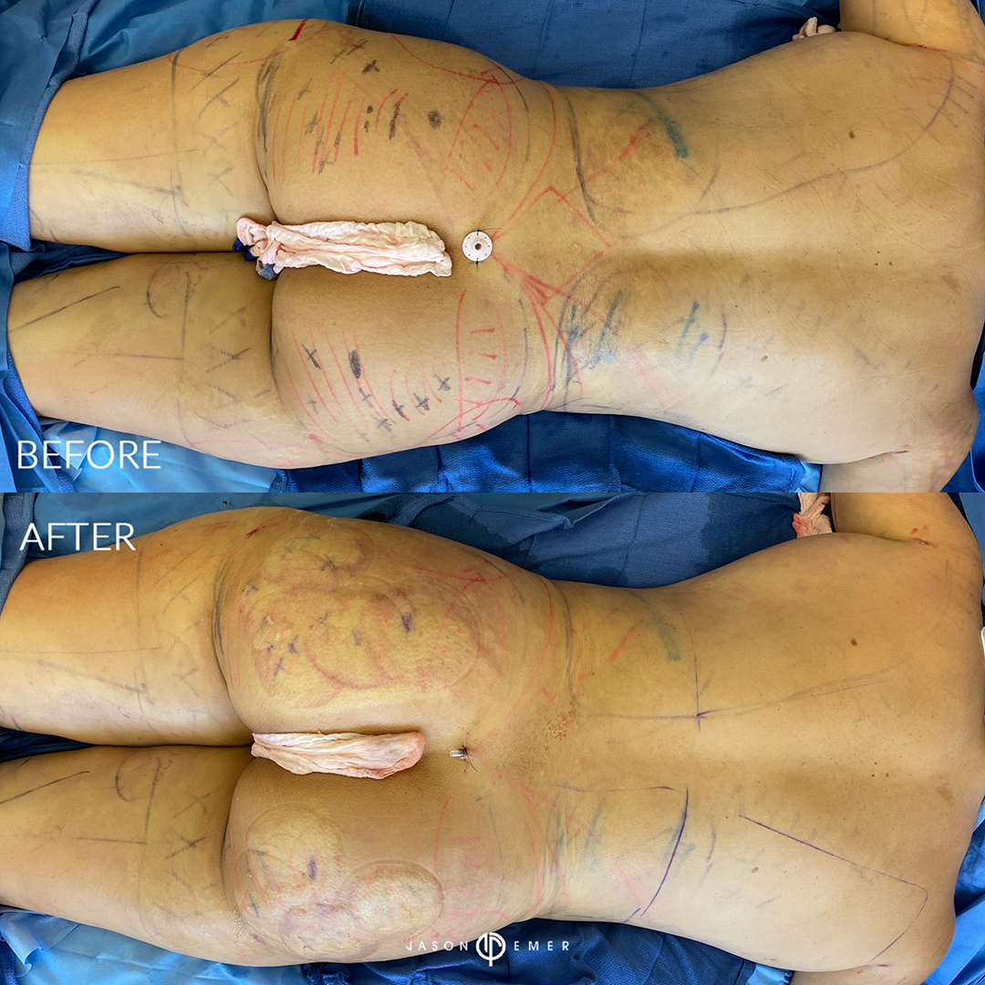 full-body-hi-def-lipo-female-bxa2