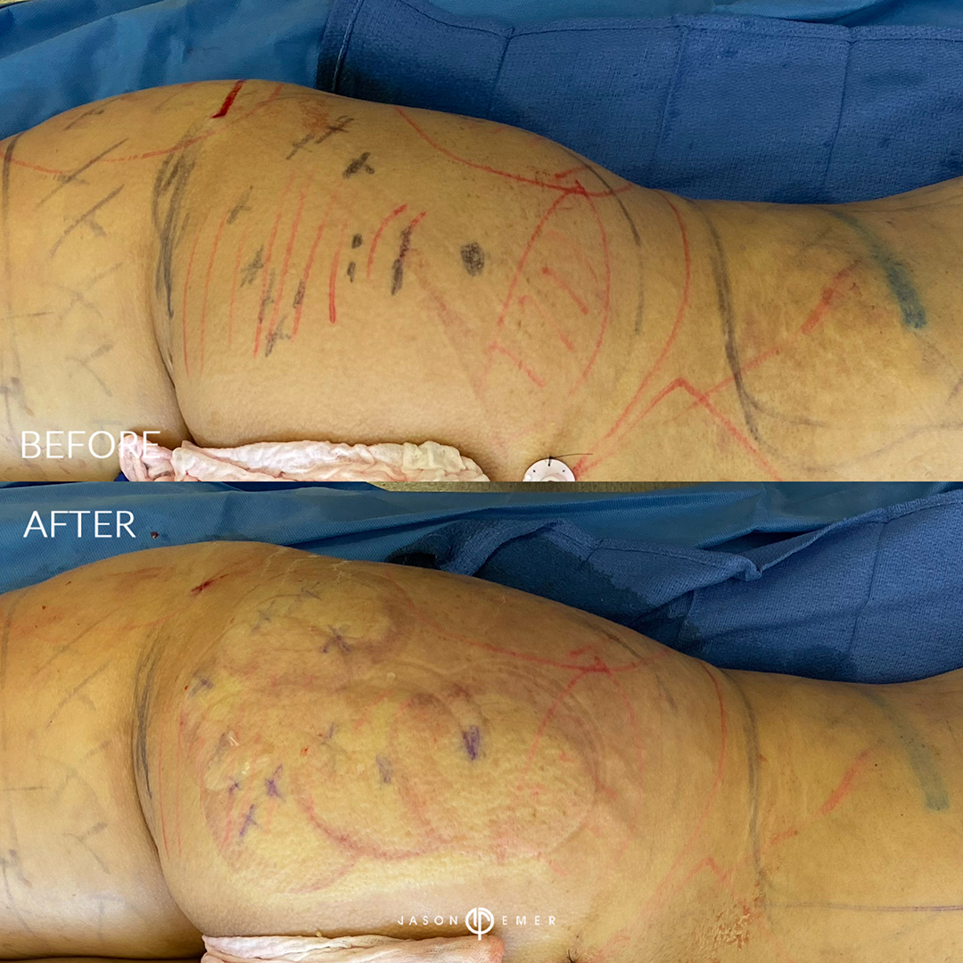 full-body-hi-def-lipo-female-bxa3