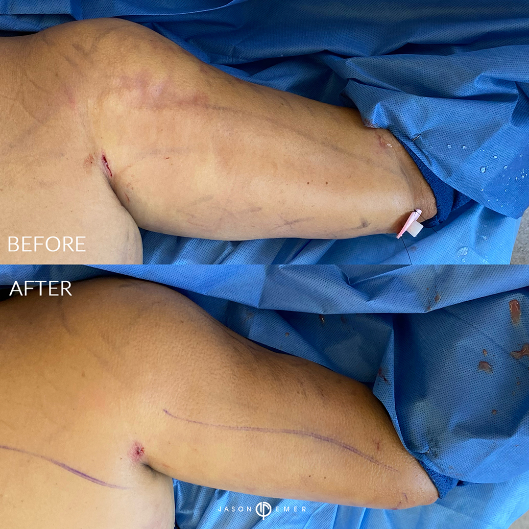 full-body-hi-def-lipo-female-bxa4